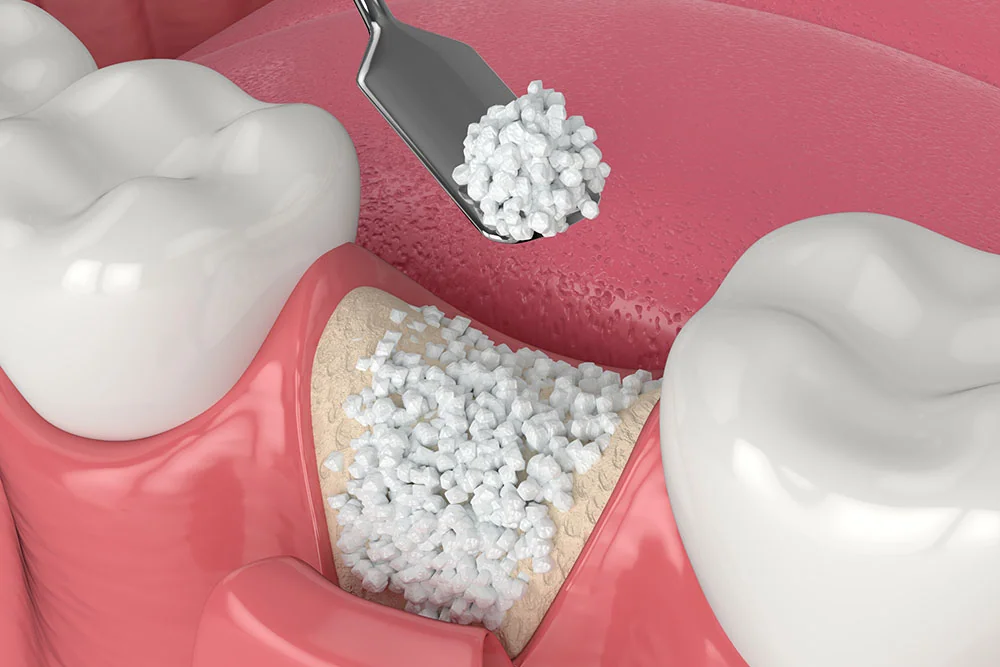 How a Dental Bone Graft Procedure Works