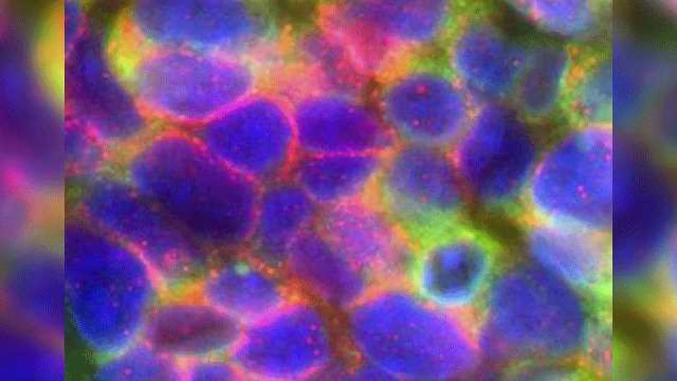 Can a Genomic Test Identify Aggressive Prostate Cancer More Effectively?