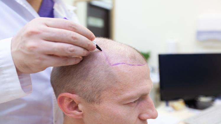 6 Factors to Consider When Debating a Hair Transplant
